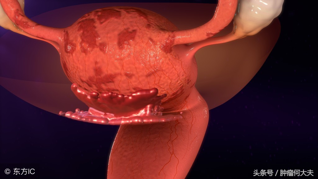 宫颈癌早期可以打宫颈癌疫苗吗,子宫癌和宫颈癌早期会发烧吗