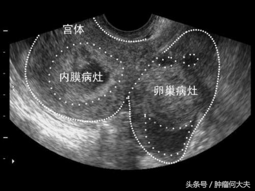 子宫内膜癌一般是什么引起的,什么是子宫内膜癌