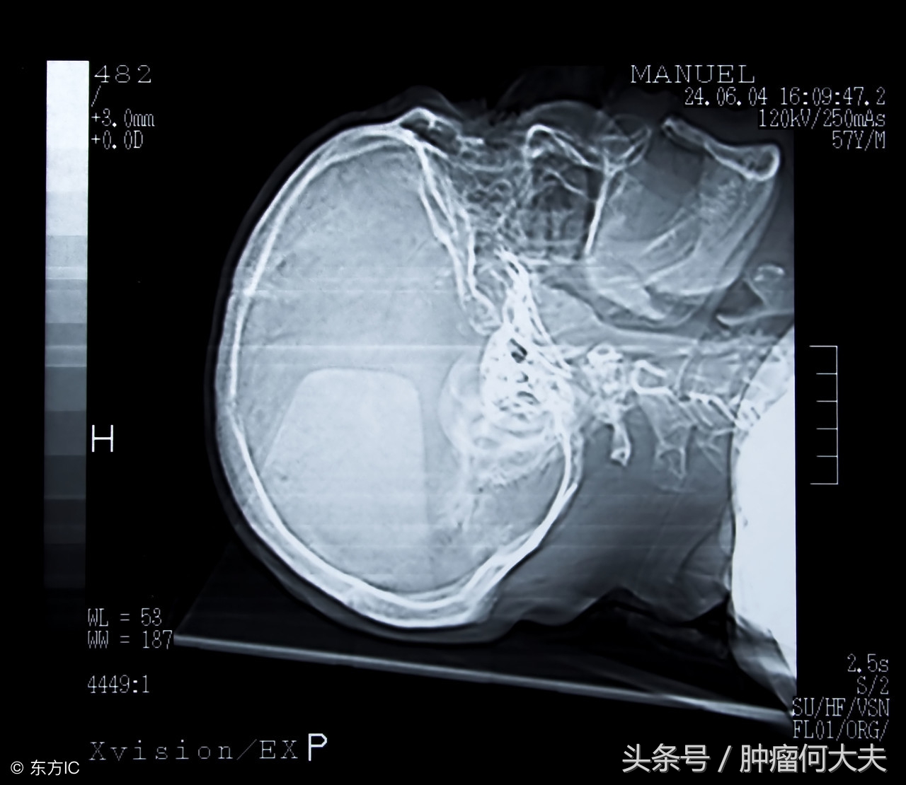 脑膜瘤是良性？恶性？症状如何？如何治疗？