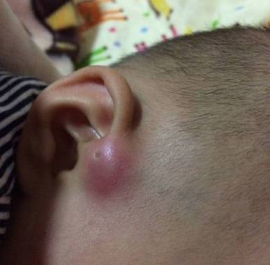 耳朵上有个小洞洞是怎么回事图片,孩子耳朵上的这种小洞该怎么办