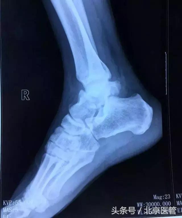 积水潭手术机器人,积水潭医院智能化机器人