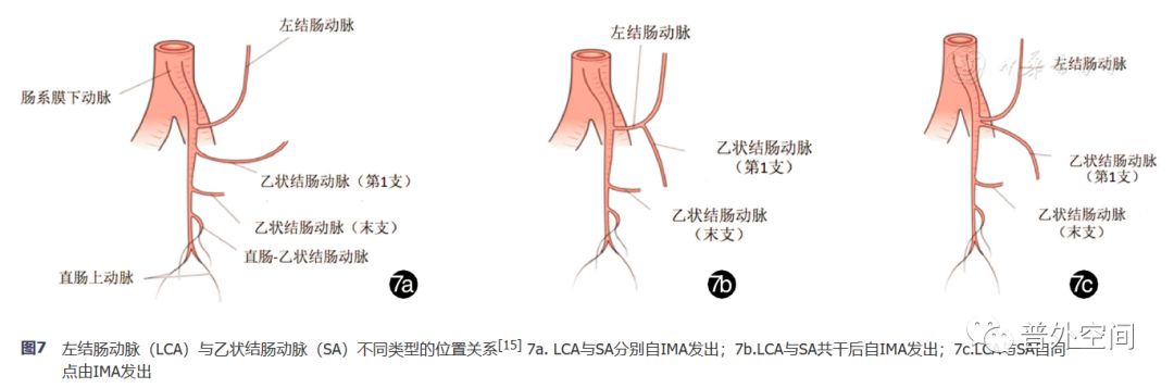 腹腔镜完整结肠系膜切除术相关血管变异与术中出血的应对措施(上)