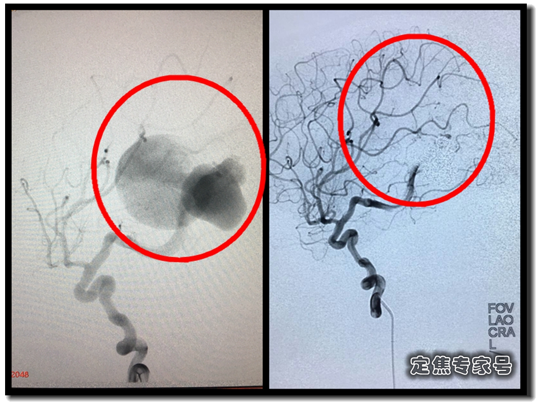 哭的时候额头爆青筋，手术发现脑子里有个“小苹果”在偷血