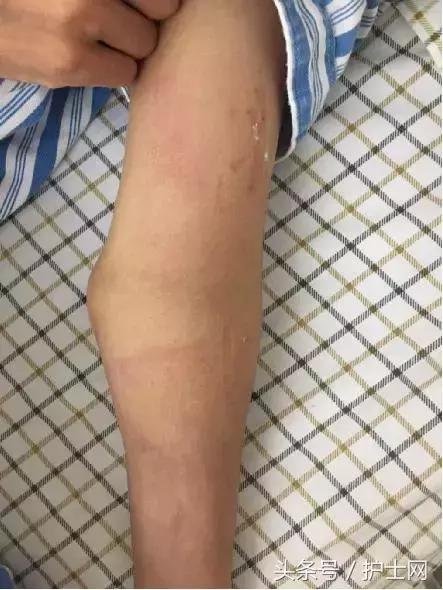 静脉炎的预防与处理,静脉炎的预防措施哪项正确