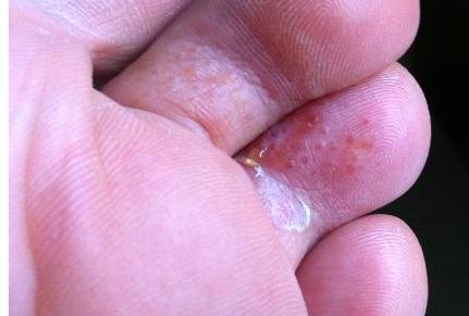 脚气引起皮质增厚怎么用药,脚气用碘伏之后可以用药吗