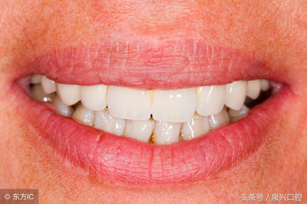 烤瓷牙的优缺点,各类烤瓷牙材料的优缺点对比