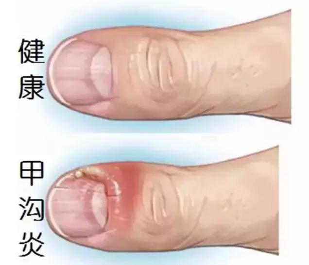 跑步脚上起血泡长什么样子,跑步大脚趾起水泡是怎么回事