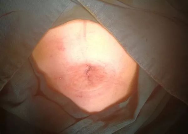 微创单孔腹腔镜手术,技术是术什么是道