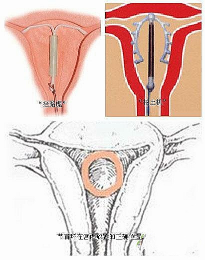 可以自己带的避孕环,不用放在宫腔的节育环