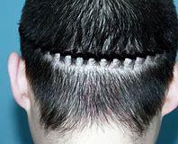 种植头发价格大概多少,种植头发价格