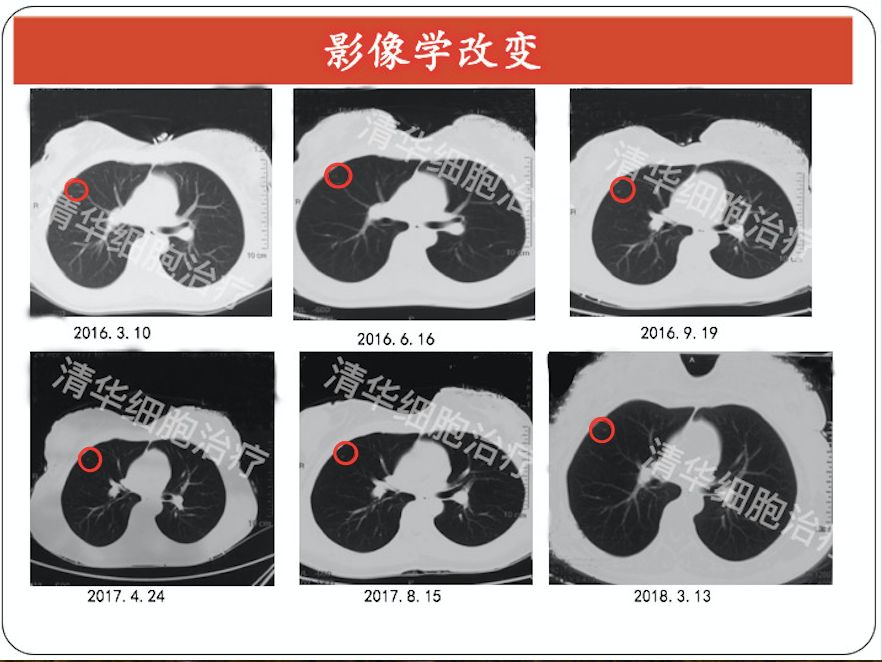 鑳冪檶nkt鍏嶇柅娌荤枟鎴愬姛妗堜緥,鑳冪檶nk鐤楁硶
