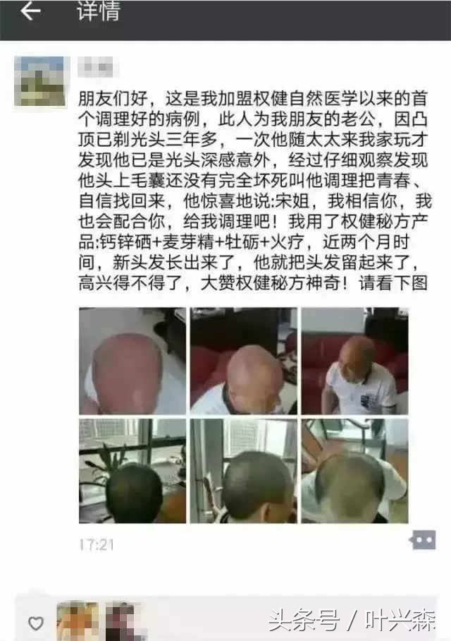 脱发掉发秃顶你该了解生发方法了,秃顶脱发最好的治疗方法