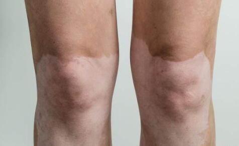 日常生活中白癜风患者应注意什么,邯郸治疗白癜风最佳时间