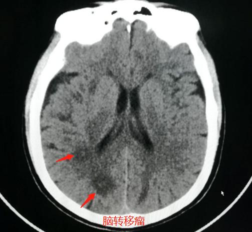 头晕、手麻，不是脑血栓，是肺癌脑转移？豪大夫讲肺结节（三）