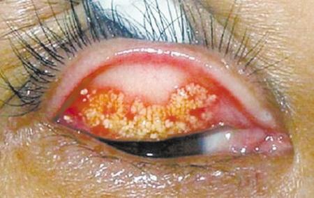 眼结石走进科学,眼结石最快排出方法