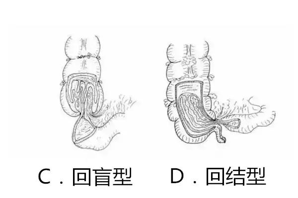 肠套叠灌肠复位后需要注意事项,小儿肠套叠空气复位