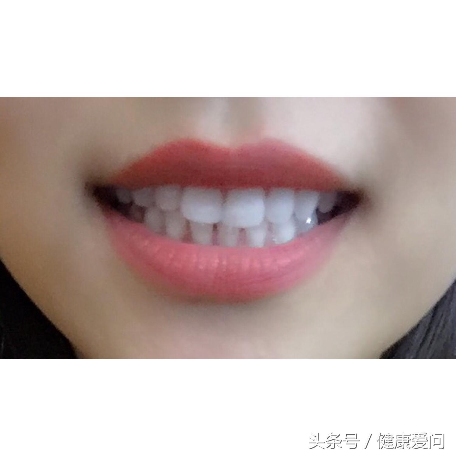 牙疼上火了吃什么中药好得快,白芷细辛三味中药治疗牙疼