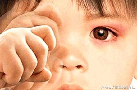 晨起眼睛眼屎多看不清,晨起有眼屎什么原因