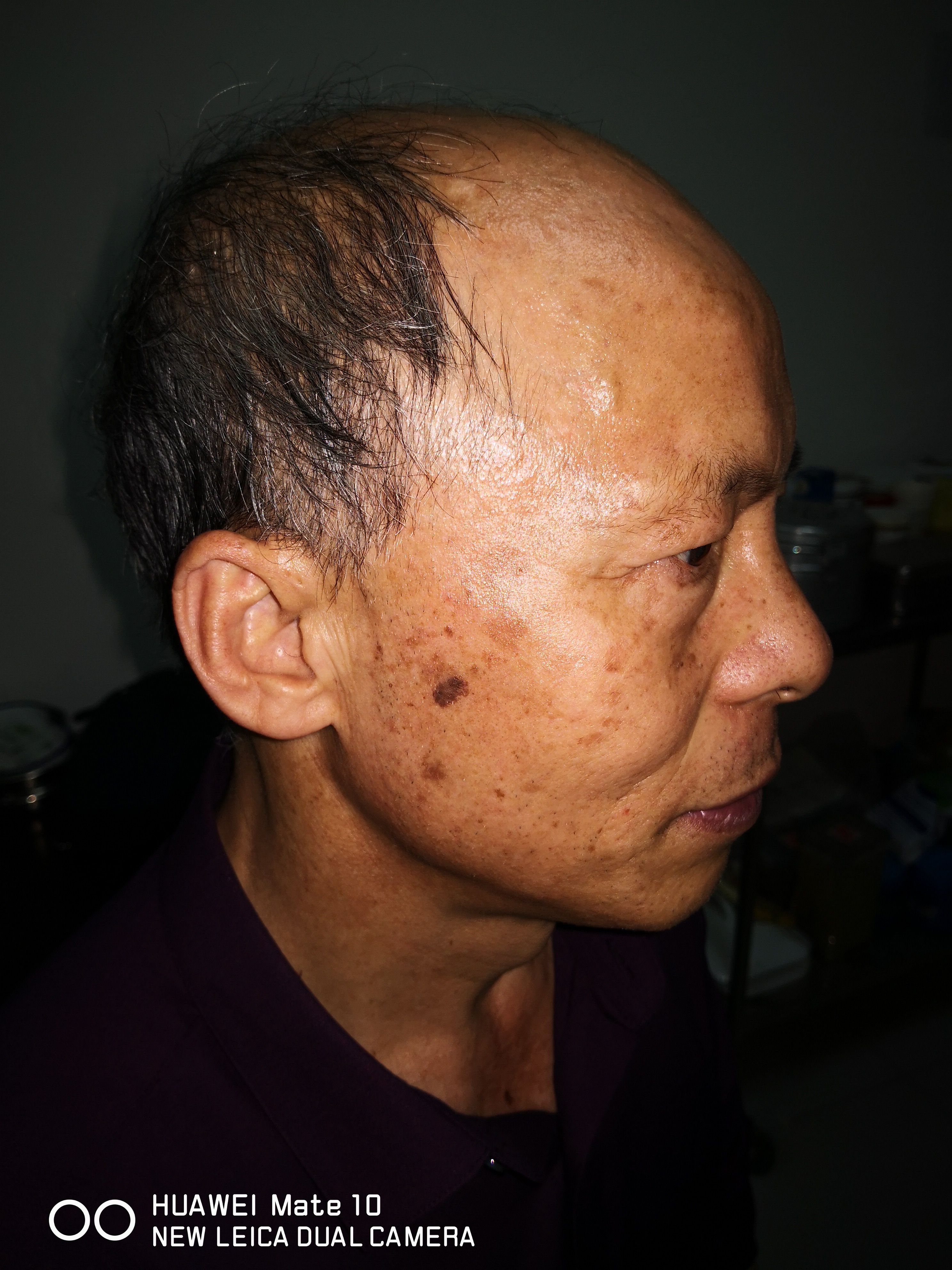 股骨头坏死二期置换好吗,遗传型脱发白发