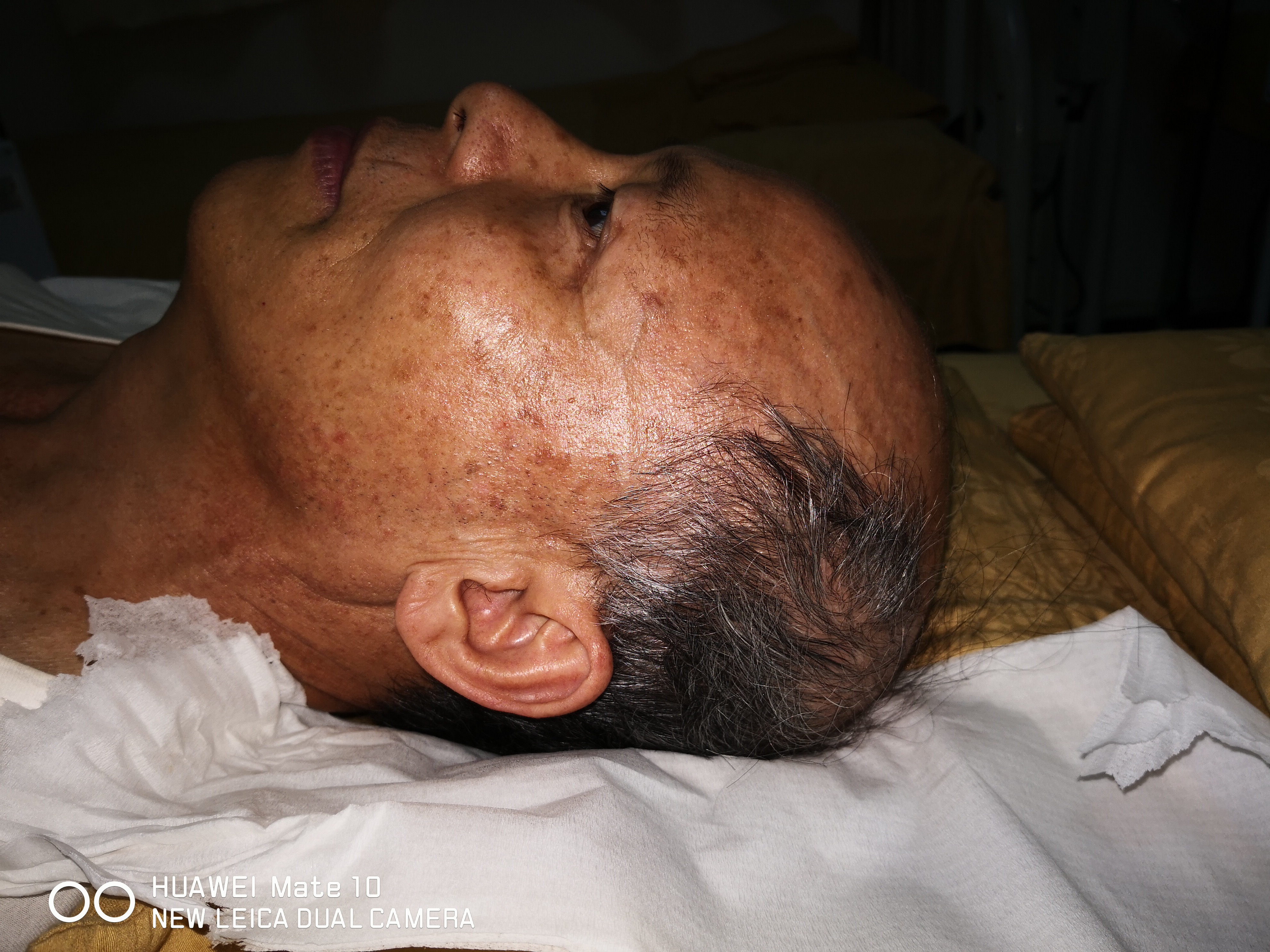 股骨头坏死二期置换好吗,遗传型脱发白发