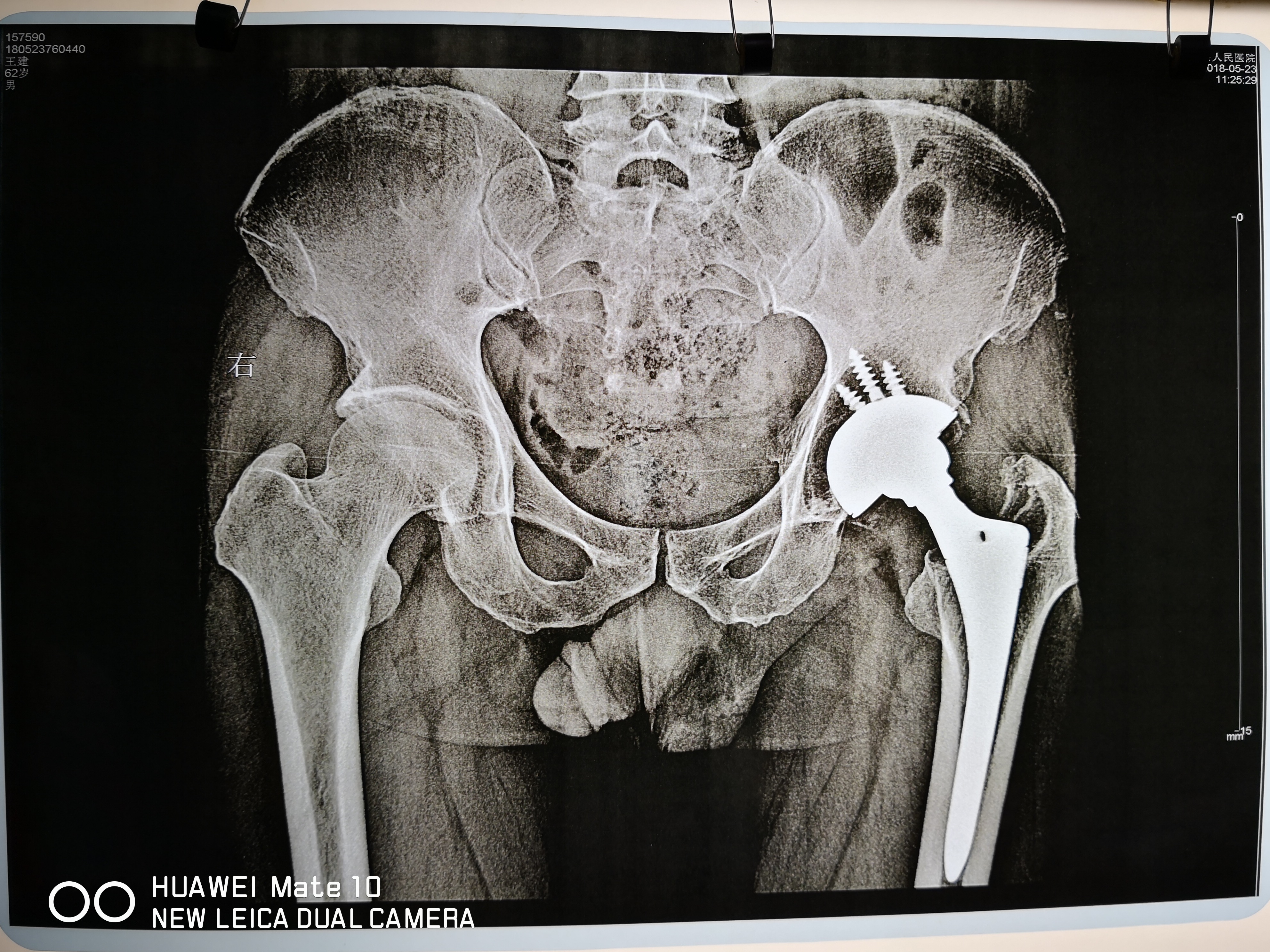 股骨头坏死二期置换好吗,遗传型脱发白发