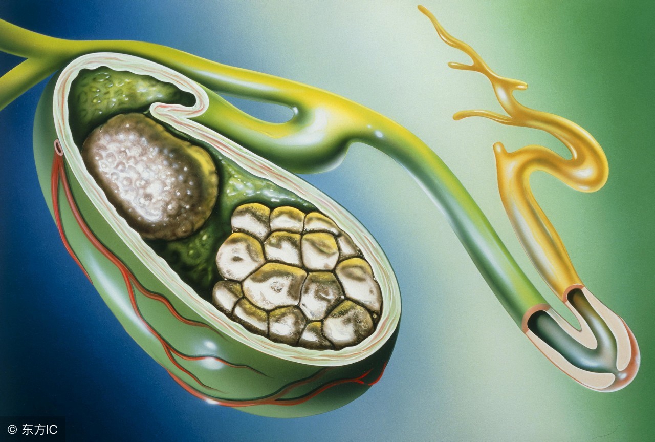 胆结石黄豆大小最佳治疗方法,胆结石的中药治疗方法有哪些