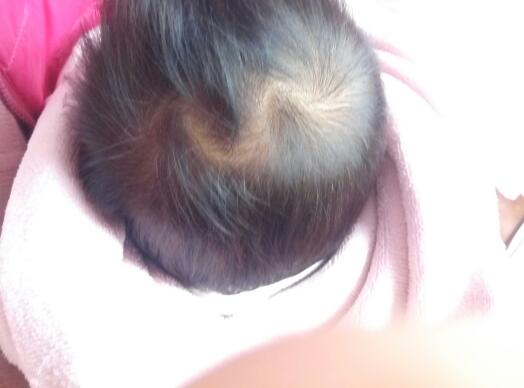 人头发后面都有个旋吗,每个人头顶都有旋么