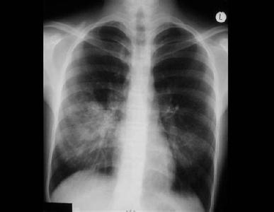 肺炎支原体感染咳嗽但肺部ct正常,小儿支原体肺炎咳嗽厉害怎么办