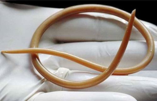 孕期感染蛔虫怎么办,孕期蛔虫病怎么办啊