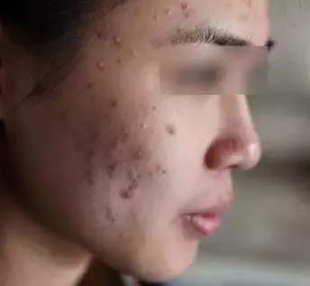 修护面部的最好用的面膜,这些面膜容易引发激素脸你知道吗