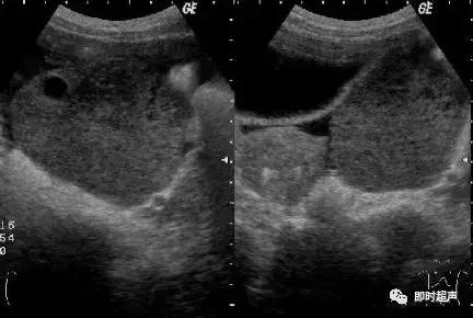 卵巢畸胎瘤的超声声像诊断,超声能不能看到卵巢畸胎瘤内部