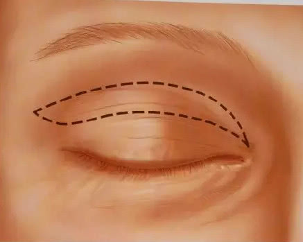 双眼皮手术过程中有烧焦味,埋线定位无痕双眼皮手术过程