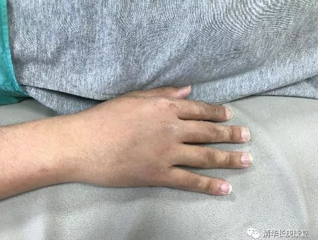 肌腱损伤的指南,长庚肌腱损伤康复训练