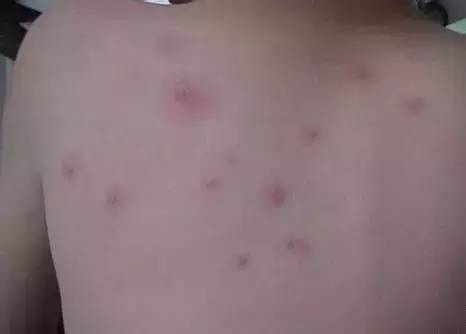 怎么区分水痘与手足口病,疱疹性咽峡炎和手足口病如何分别