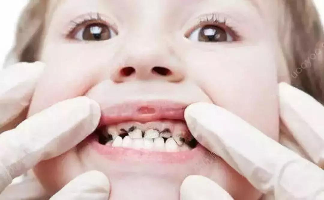 儿童乳牙有点蛀了怎么办,儿童乳牙蛀了要怎么办