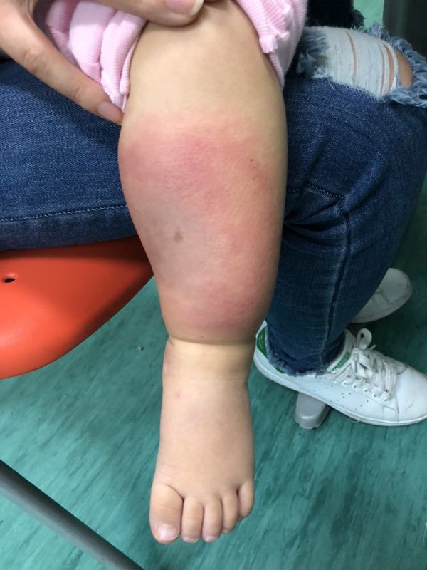 宝宝被蚊虫叮咬最好的解决办法,宝宝被蚊虫叮咬后有什么好办法吗