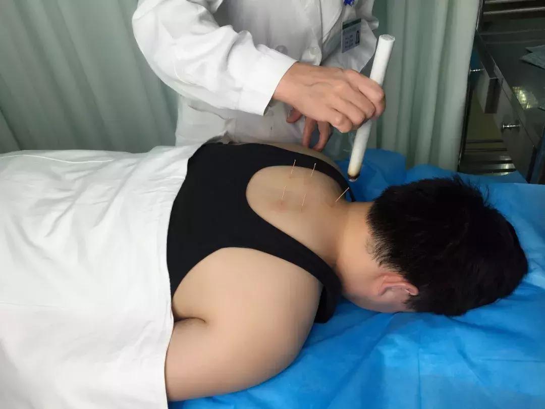 图解,看“邵氏五针法”治疗哮喘