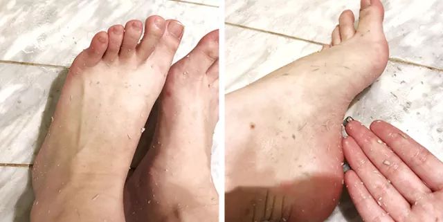 擦掉一块皮用什么药,擦掉了一小块皮一般需要多久恢复