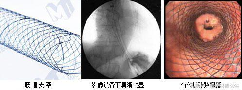 癌症晚期无法进食全身浮水,癌症晚期无法排便怎么回事