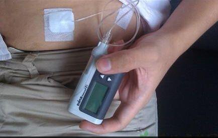 胰岛素泵多少钱一个,胰岛素泵一般多少钱一台