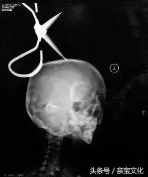 2岁女宝吐了十几次,2岁儿童一天吐10次