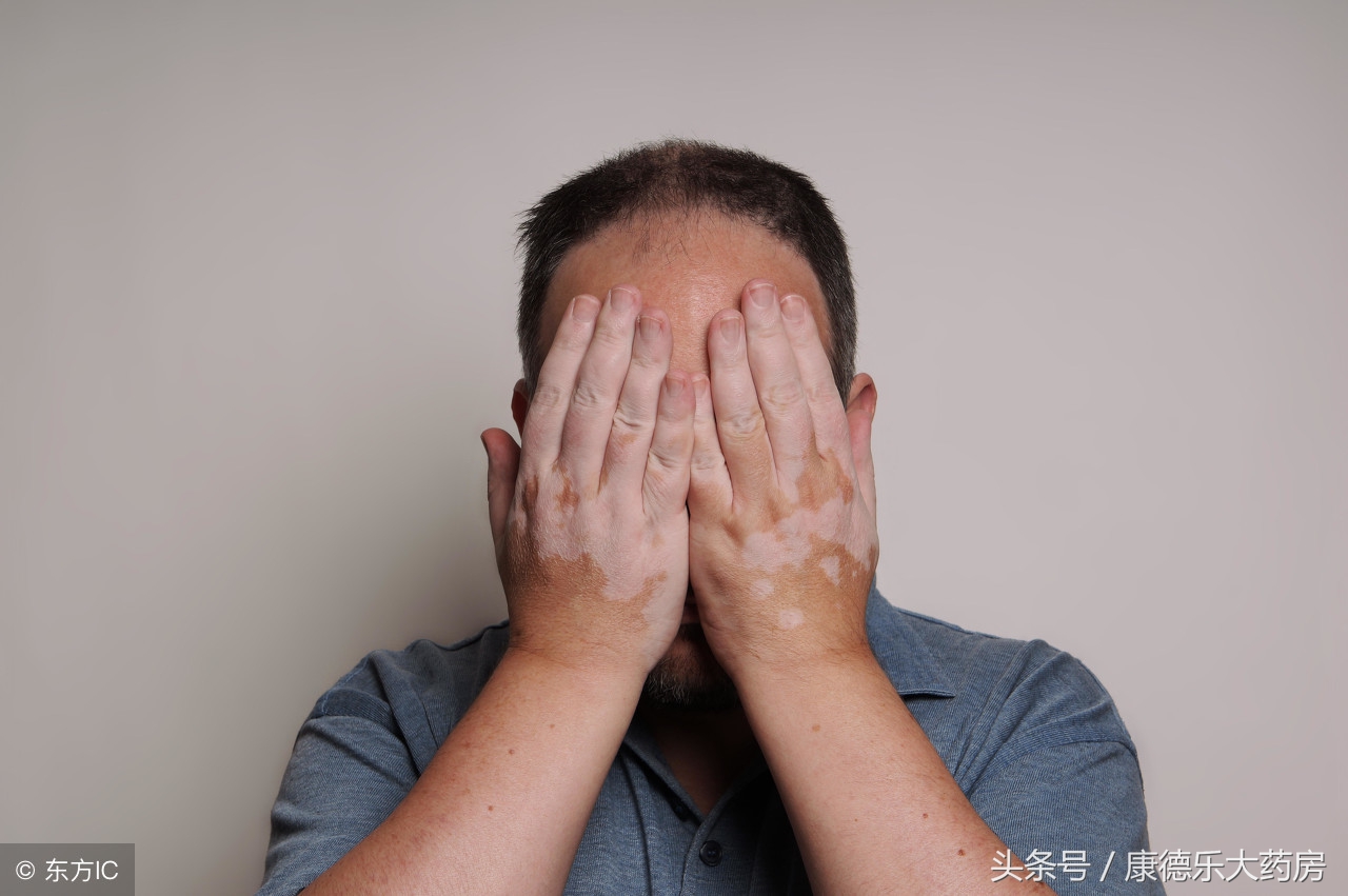 夏天是白癜风的高发季节早发现早治疗是关键