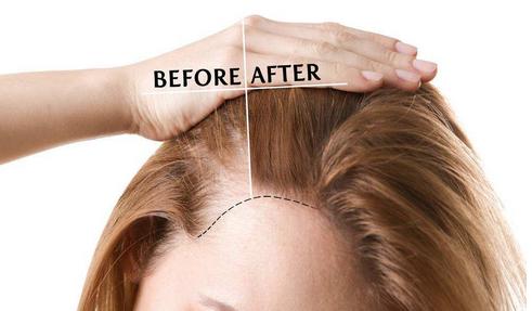 女性产后脱发吃什么药,女性产后大出血导致脱发