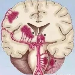 脑出血分期及影像学表现,脑出血各个部位的临床表现
