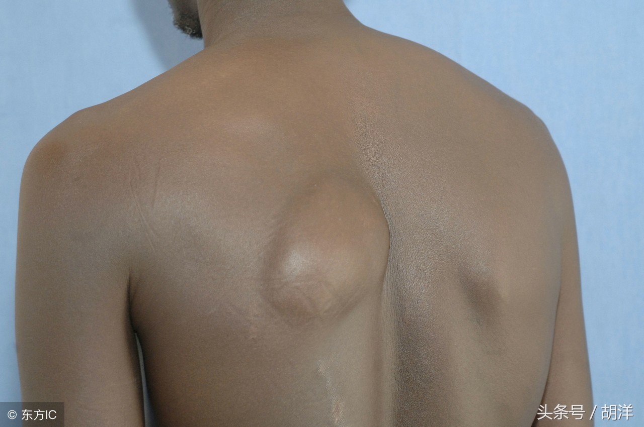 大脑脂肪瘤会变成恶性肿瘤吗,肾上腺髓质脂肪瘤是恶性肿瘤吗