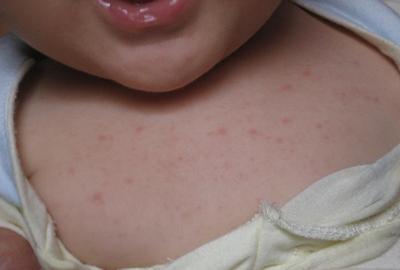 宝宝除痱爽身露夏季推荐,哪款婴儿祛痱爽身露好用