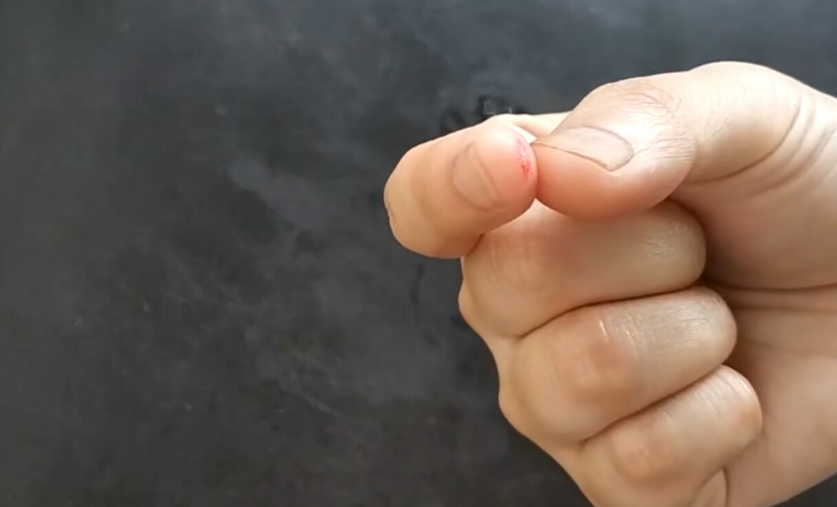 手里进了很小很小的刺怎么办,手里进刺不拔没事吗