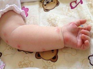 这个季节常见儿童皮肤病,芬母治疗婴儿湿疹冒水效果怎样