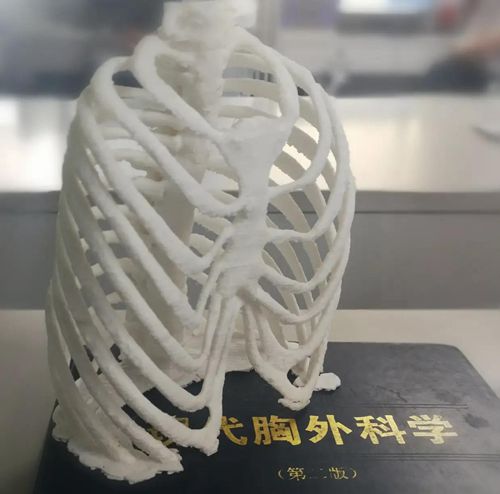 年龄大的重症漏斗胸可以动手术吗,成年人漏斗胸没有症状需要治疗吗