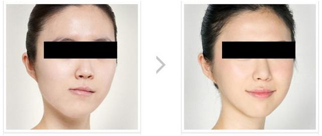 歪瓜裂枣好不好,歪瓜裂枣的牙齿好矫正吗